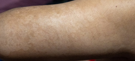 Close-up of men's arm with dry skin on it with the disease tinea versicolorの写真素材