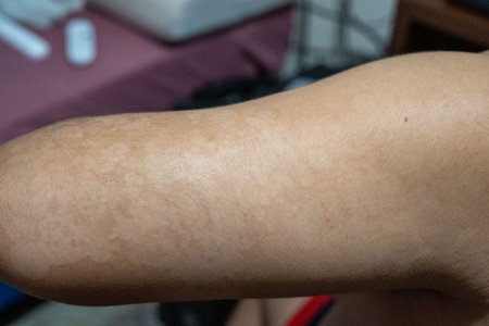 Close-up of men's arm with dry skin on it with the disease tinea versicolorの写真素材