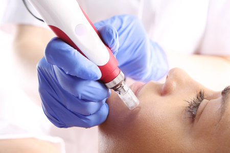 Rejuvenation, beautification, the woman at the beautician, Mesotherapy microneedleの写真素材