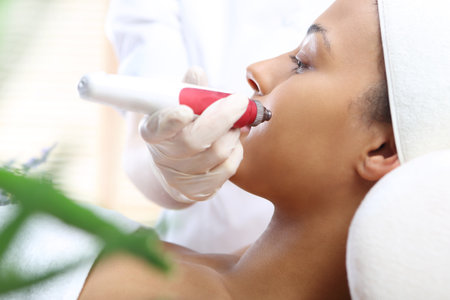 Mesotherapy microneedle, the woman at theの写真素材