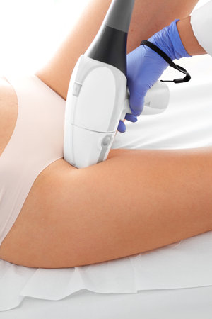 Laser in aesthetic medicine. Epilation Woman on laser hair removal treatments thighs and bikini areaの写真素材