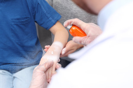 Soothing dressing, first aid for burns. The doctor puts the foam on the child's burned handの写真素材