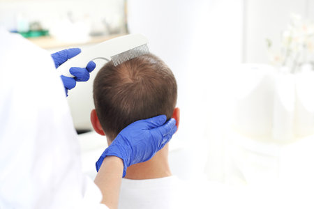 Oxygen therapy of the scalp and hair follicles. The head of a man with thinning hair during a care treatmentの写真素材