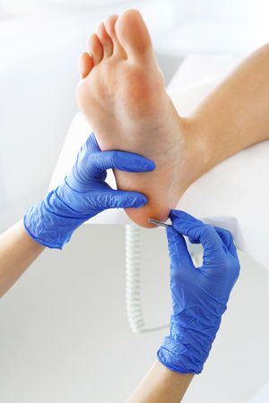 Podiatry. Removing calluses with a scalpel at the beautician.の写真素材