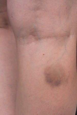 Hematoma, bruise on woman arm, pain concept closeup.