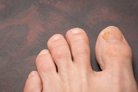 Toenails with fungus problems, Onychomycosis, also known as tinea unguium, is a fungal infection of the nail, dark background.の写真素材