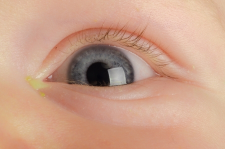 Pink eye  Conjunctivitis  infection on a babyの写真素材