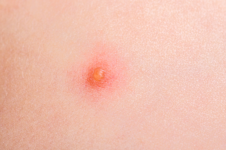Chickenpox close up on  the skin of a white childの写真素材