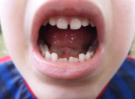 detail of mouth with milk teethの写真素材
