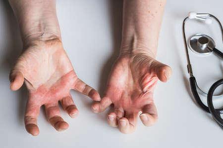 Red, itchy hands with blisters. Atopic dermatitis. A visit to a dermatologist, a stethoscope on the deskの写真素材