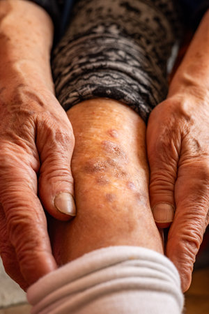 Eldery woman shows leg with skin disease. Diseases of older people, Senior health, skin ulcers and psoriasisの写真素材