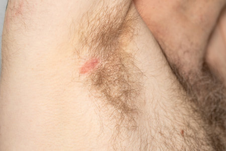 Neglected armpits and skin lesions, Health concept, hygiene and skin diseases