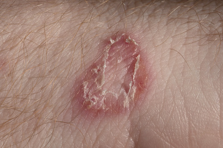 Ringworm on white man skin / Fungus Infection / Mycosisの写真素材