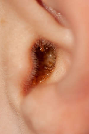 Photo of an ear full of earwax. Close-up ear. Personal hygiene. Depth of field