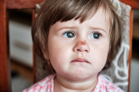 Portrait of a sad little girl with a scratched nose, close-up, selective focus. Child safety concept, injuries from falling down. Child is no longer cryingの写真素材