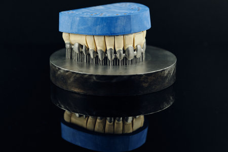 Tooth dental crowns created on 3d printer for metal. Gypsum model on a printed metal frameの写真素材