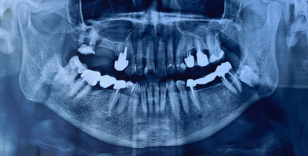 Close-up of image panoramic x-ray of teeth and jaw human as example