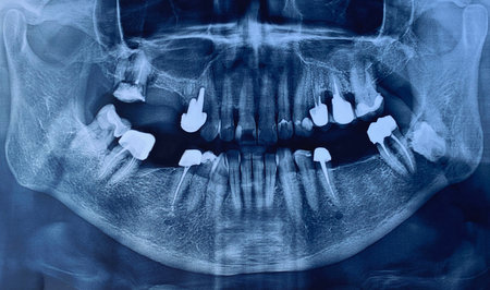 Close-up of image panoramic x-ray of teeth and jaw human as exampleの写真素材