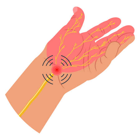 Carpal tunnel syndrome vector of a medical illustration of a wrist with a painful area of nerve of the hand isolated on a white background.のイラスト素材