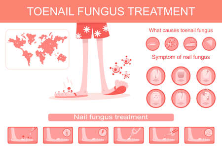 Toenail fungus treatment medical infographics. Vector cartoon flat illustration of infection, symptoms and therapy of nail and stop disease.のイラスト素材