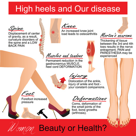Infografics  woman: High heels and Our disease.  Vector illustration.のイラスト素材