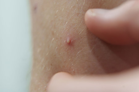 Fingers pressing on a small pimple on human skin, showing acne and skin imperfections up close.の写真素材