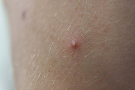Closeup of a red pimple on human skin, showing inflammation and acne with visible hair and pores.の写真素材