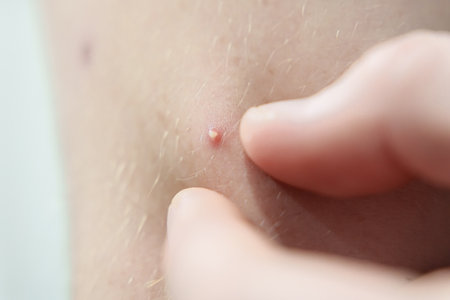 Fingers pressing on a small pimple on human skin, showing acne and skin imperfections up close.の写真素材