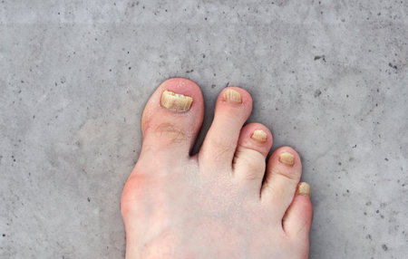 Foot with fungus damaged nails close upの写真素材