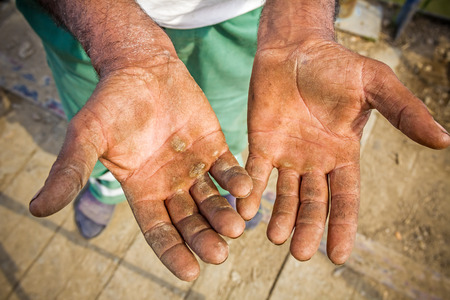 Worker is showing his chapped hands, dirty and injured palms.の写真素材