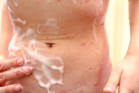 Child skin infected with chickenpox is having treatment using antiseptic foam.