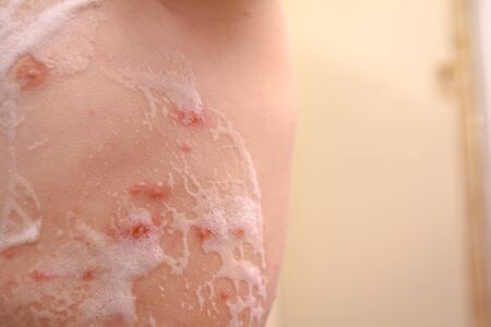 Child skin infected with chickenpox is having treatment using antiseptic foam.