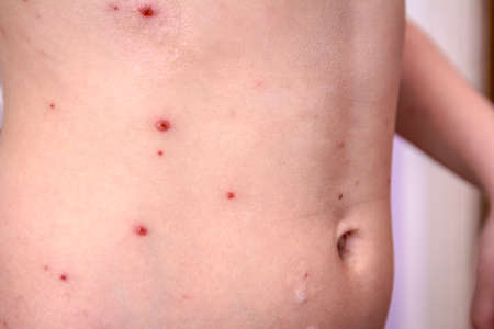 Child skin infected with chickenpox is having treatment using antiseptic foam.の写真素材