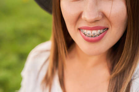 Smile not ashamed of braces, smile of a girl close-up, self-ligating braces. High quality photoの写真素材