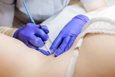 hair follicle removal with electrolysis close-upの写真素材