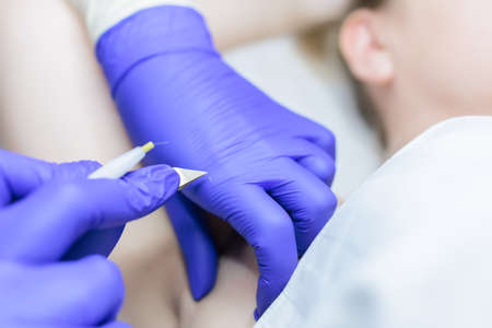 hair follicle removal with electrolysis close-up