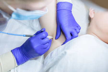 hair follicle removal with electrolysis close-upの写真素材