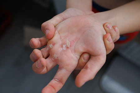 Torn skin on the palm of my hand from a hard workout, A lacerated callus on the palm of my hand.の写真素材