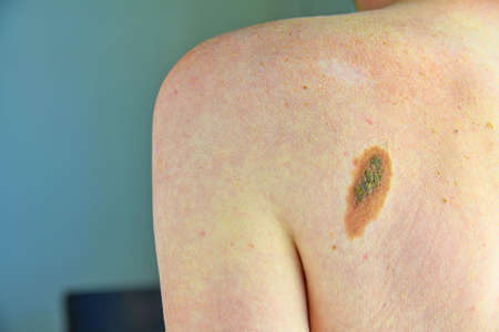 Hairy skin mole. Close up picture of dangerous brown nevus on human skin - melanomaの写真素材
