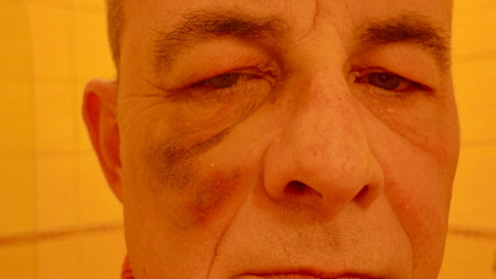 A bruise on an elderly man's cheek. Bruise and swelling on the face.の写真素材