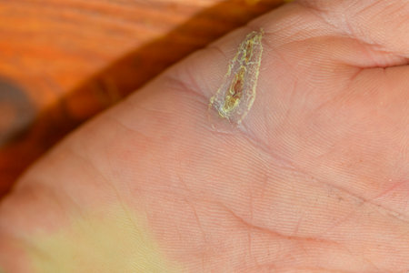 Wound healing on the hand. Wounds on the hand and the recovery of the injury. Concept of health and self-care.の写真素材