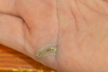 Wound healing on the hand. Wounds on the hand and the recovery of the injury. Concept of health and self-careの写真素材
