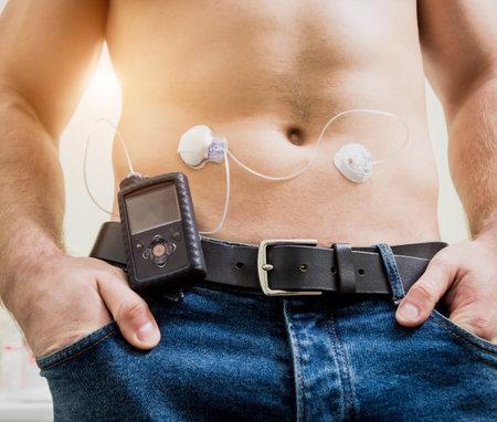 Diabetic man with an insulin pump connected in his abdomen