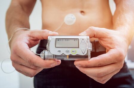 Diabetic man with an insulin pump connected in his abdomen and holding the insulin pump at his hands. Diabetes concept.の写真素材