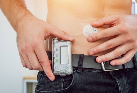 Diabetic man with an insulin pump connected in his abdomen and keeping the insulin pump on his belt. Diabetes concept.の写真素材