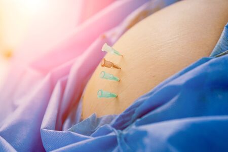 Arthroscope surgery. Orthopedic surgeons in teamwork in the operating roomの写真素材