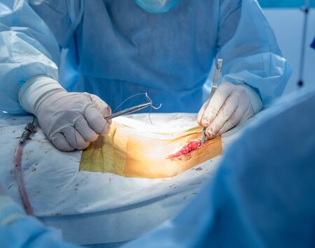 Spinal surgery. Group of surgeons in operating room with surgery equipment. Laminectomy. Modern medical backgroundの写真素材