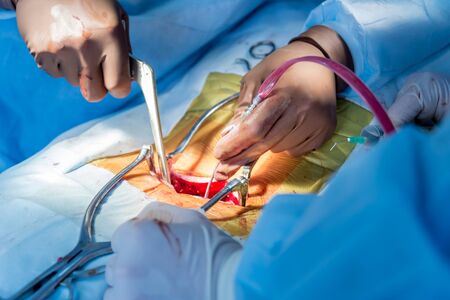 Spinal surgery. Group of surgeons in operating room with surgery equipment. Laminectomy. Modern medical backgroundの写真素材