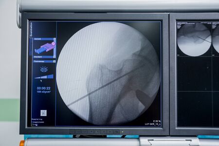 Process of trauma surgery operation. Group of surgeons in operating room with surgery x-ray equipment. Medical backgroundの写真素材