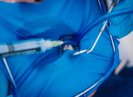 Medicamentous treatment of root canals during endodontic treatment. Modern technologyの写真素材